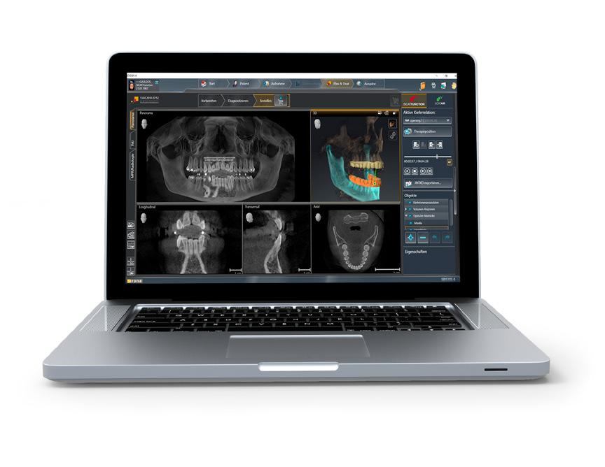 SICAT FUNCTION bietet erstmals einen integrierten Workflow in 3D zur Diagnose und Therapie von Craniomandibulärer Dysfunktion.
