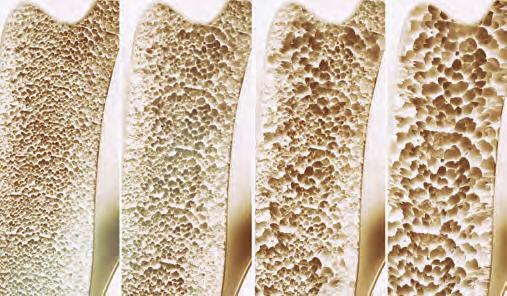 nochensch Osteoporose Bei der Osteoporose handelt es sich um eine Erkrankung des Skeletts. Die Knochen können auf grund abnehmender Knochendichte leichter brechen.