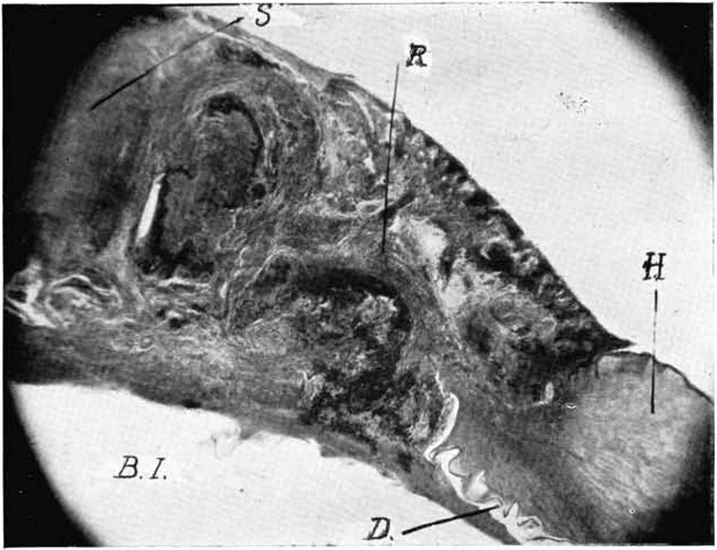 R = Rupturstclle, in der last die ganze Iris und Corpus ciliare knäuelartig aufgewunden