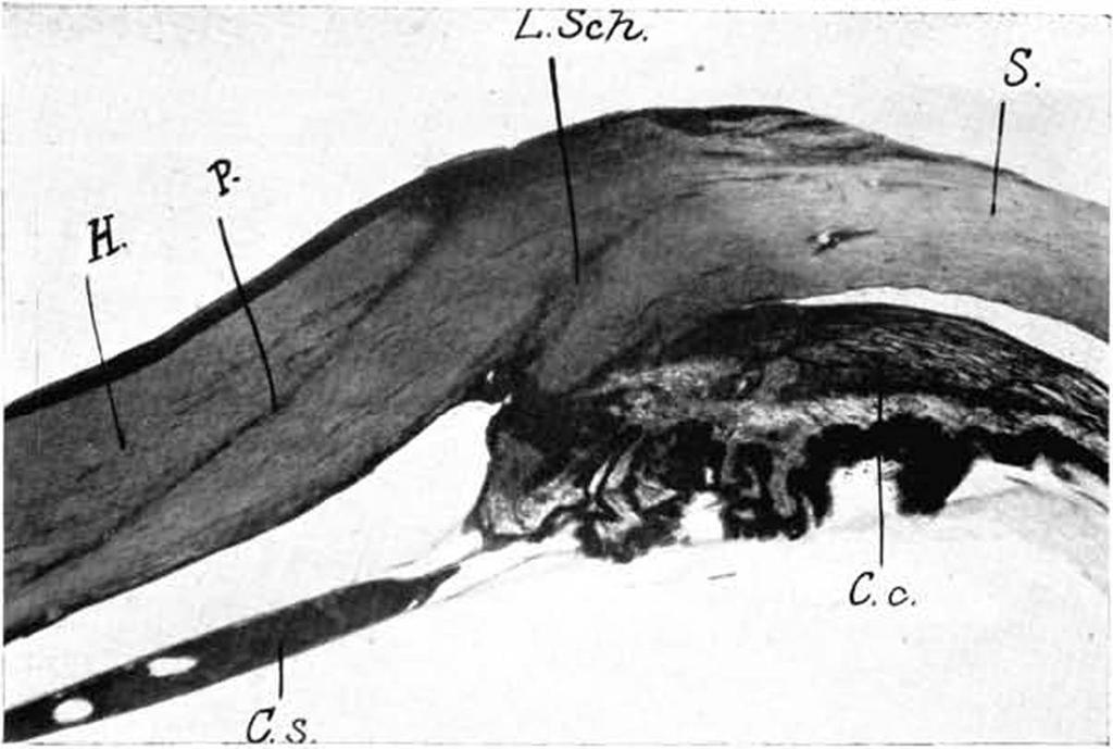 Lappenextraktion. II = Hornhaut. S Sklera. C. c. = Corpus ciliare. C. s. = Cataracta secundaria.