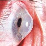 1) der Hornhaut kommt. DIE HORNHAUT (CORNEA) Die Hornhaut ist die äußere, transparente Schicht des Auges.