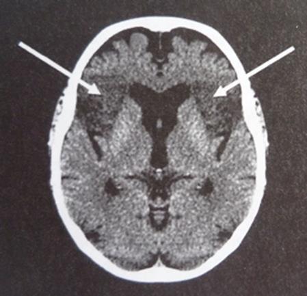 Schlaganfall häufigste Ursache neurogener Dysphagie! Dysphagie bei ca.