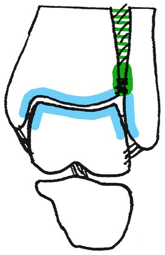 knöcherne Führung alus (Sprungbein) alusrolle, ventral breiter als dorsal: maximale Stabilität in Dorsalextension (Standbein), mehr Spiel in Plantarflexion (Spielbein) I Frontalschnitt i A