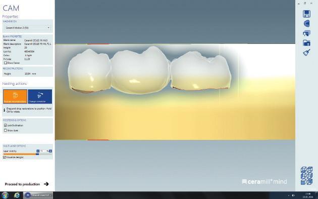 Monolithische, hochtransluzente Restaurationen aus Zirkonoxid sind derzeit stark nachgefragt auf dem Dentalmarkt.