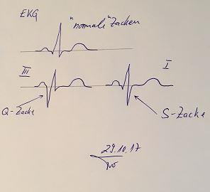 EKG (Herzstromkurve) Lungenembolie