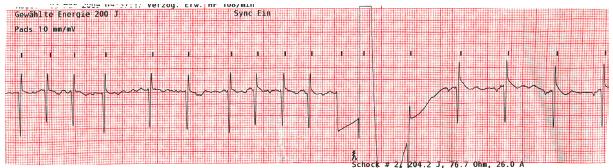 17.04.16 Elektrische Kardioversion Erfolgsrate: bei externer elektrischer Kardioversion 80-85% (monophasisch), 90% (biphasisch); intrakardial 90%.