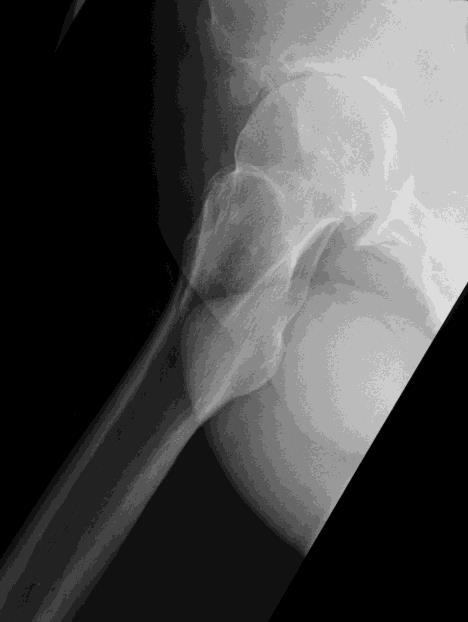 Röntgenbilder einer fortgeschrittenen Arthrose der rechten Hüfte (= Coxarthrose): Links: Ansicht von vorne.
