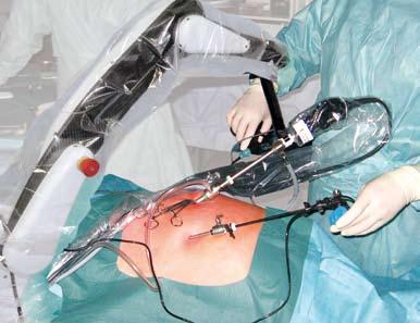 Sicheres und steriles Arbeiten Durch das stabile Bild kann der Chirurg entspannter arbeiten. Ein sicherer Blick auf das Wesentliche.