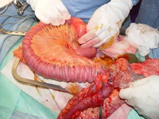 Rezidivblutungen 9-33% Angiodysplasien Endoskopie
