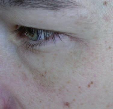 Deutlich ist die bräunlich schwärzliche Verfärbung der Haut, vom äußeren Augenwinkel ausgehend, festzustellen.