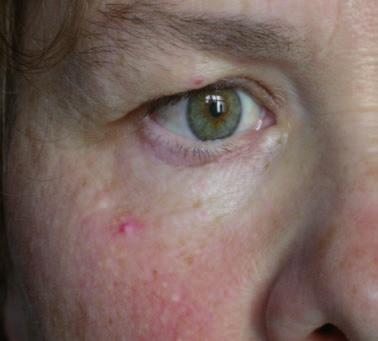 Vom milchig Rötlichen am unteren Augenlid geht das Mangelzeichen an Kc nach unten in reines Milchig über. Der Hautgrieß verstärkt diesen Mangel.