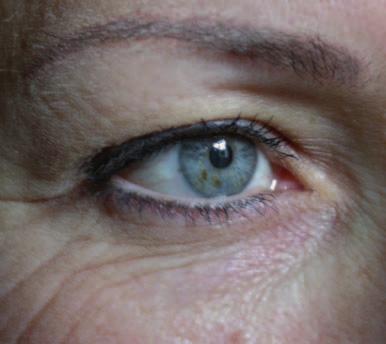 In beiden inneren oberen Augenwinkeln bei relativ tief liegenden Augen zeigen sich deutliche Aussackungen, die auf einen außerordentlich starken  Beginnendes