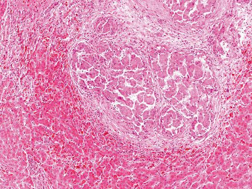 Atlas der Leberbiopsien 366e Abbildung 366e-21 Zirrhose infolge einer Hämochromatose mit