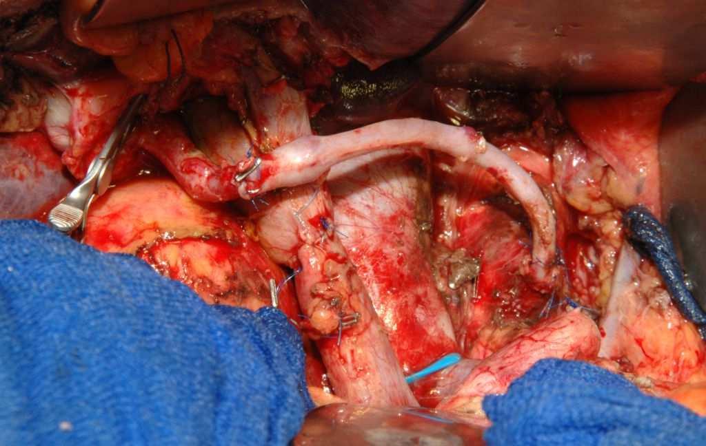 Arterielle Resektion saphenous vein interposition graft aorta
