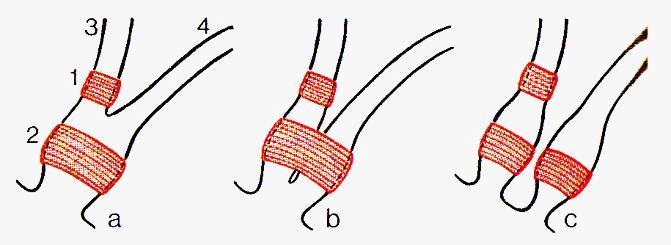 Ductus pancreaticus accessorius