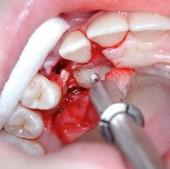 999,00 EUR Extraktionssystem nach Benno Syfrig, Dr. med., med. dent. In der modernen Zahnheilkunde steht die Implantologie nach der Zahnentfernung zunehmend im Mittelpunkt.