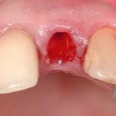 Behandlung der Zahn alveole nach der Extraktion.