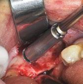 957.70 Ersatzhülse EUR 16,80 (UVP) In der oralen Chirurgie werden Knochenersatz- und Knochenaufbaumaterialien bei Augmentationen oftmals mit autogenen Knochenspänen