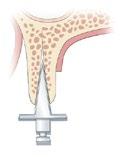 Valentin Entscheidend für den Erfolg einer Implantation ist primär ein ausreichendes Knochenangebot im Bereich des Alveolarfortsatzes und insbesondere dessen Qualität.