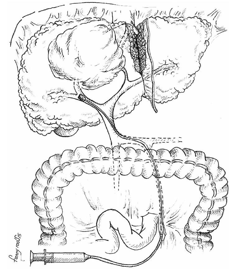 In-situ Split Department of Visceral-,