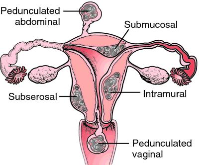 Tumoren: Uterus Tumoren der glatten Uterusmuskulatur: Leiomyom und Leiomyosarkom Endometriumtumoren Endometrioide Adenokarzinom: Vorläuferläsion: Atypische