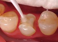 SIE PROFITIEREN VON: Verringerter Dentinempfindlichkeit dank Versiegelung der Dentinoberfläche Kurzer