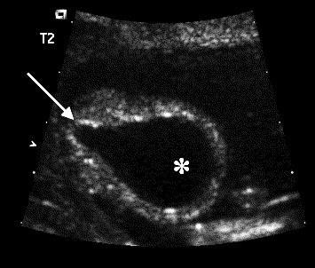 in der posterioren Urethra ( ), dilatierte proximale Urethra und Trabekelharnblase( ) 42 B: Fetale Sonografie,