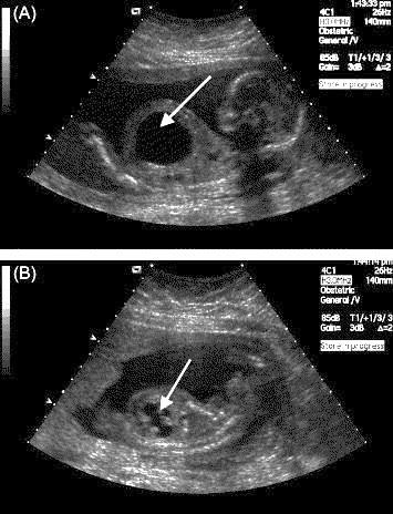 alten Fetus 18 Die Möglichkeit der pränatalen Diagnostik führte zu fetalen Interventionen, wobei am häufigsten ein