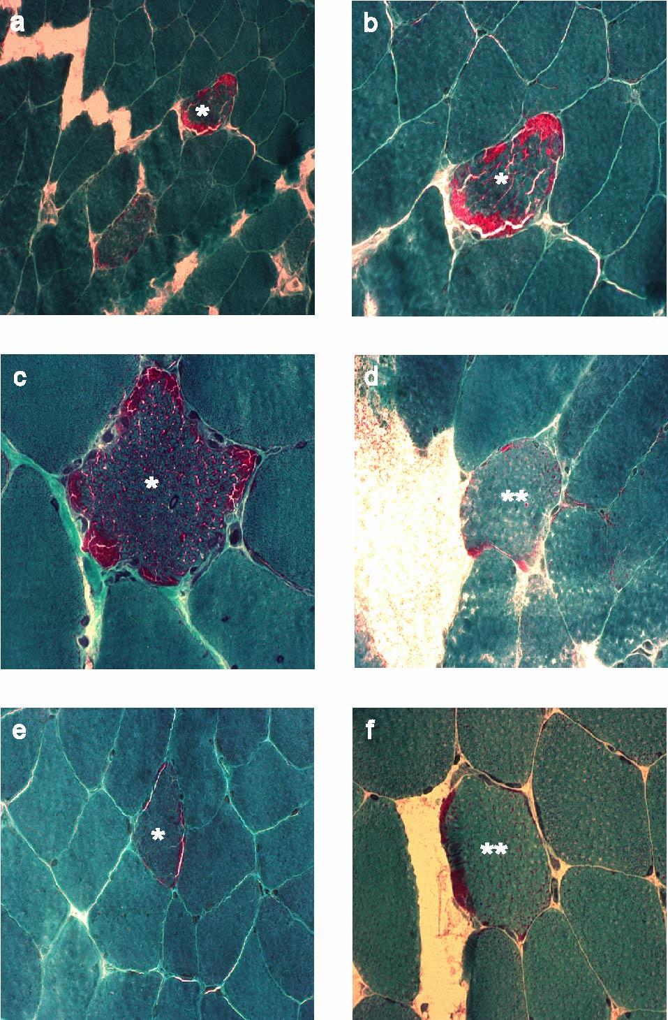 3 Ergebnisse Abbildung 13: Myohistologische Veränderungen in der modifizierten Gomori-Trichrom Färbung.