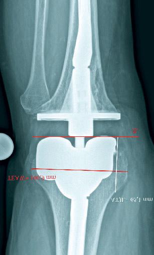 Wie lange knie krank schlittenprothese OZF: Schlittenprothese