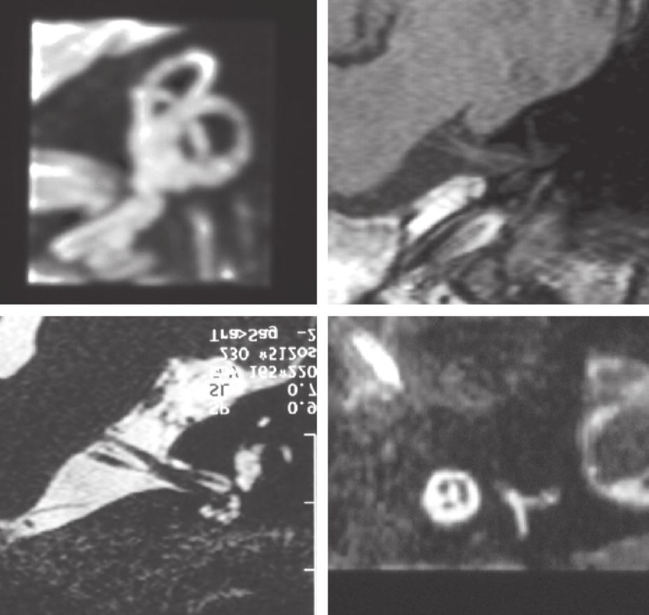 7. Untersuchungstechnik in der Schnittbildgebung. Abb..2A D. Schläfenbeindarstellung im MRT. A Axiales CISS-Bild, auf das linke Schläfenbein vergrößert.