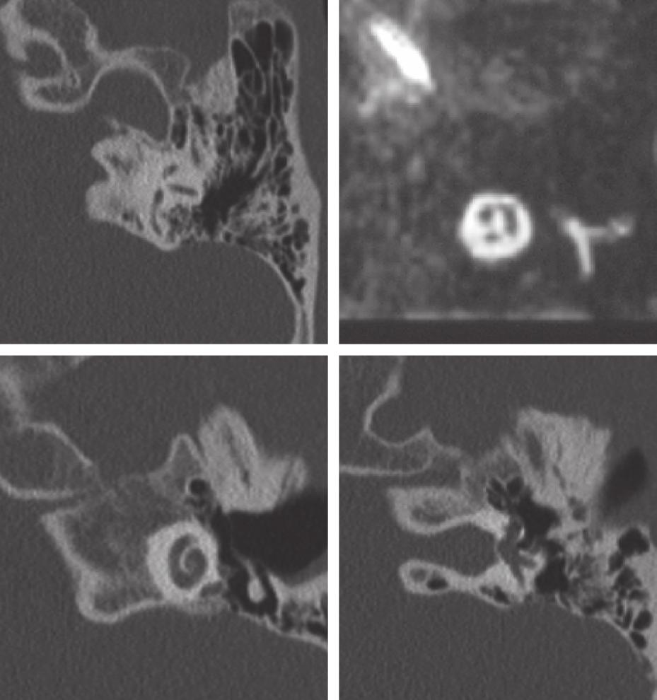 5.2 Anatomische Strukturen in der Schnittbildgebung. Abb..5A D. CT- und MRTAnatomie des Innenohrs. A C Koronare CT-Bilder von ventral nach dorsal.