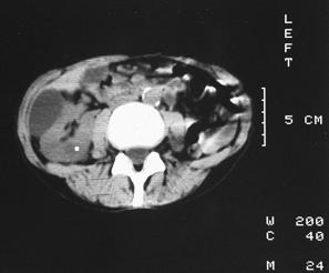 Nierenzysten - CT kugelförmig glatt konturiert hypodens Keine Wand HE < 20