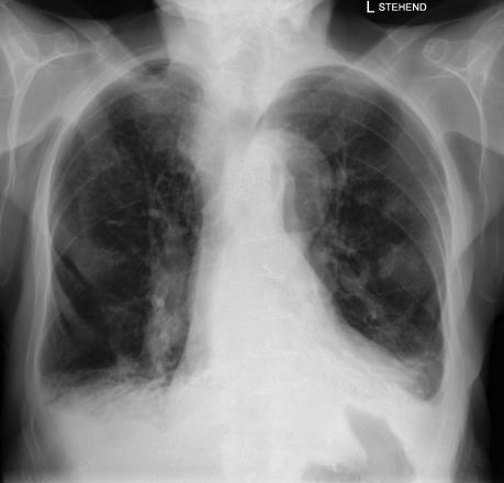 COPD eine systemische Erkrankung Respir