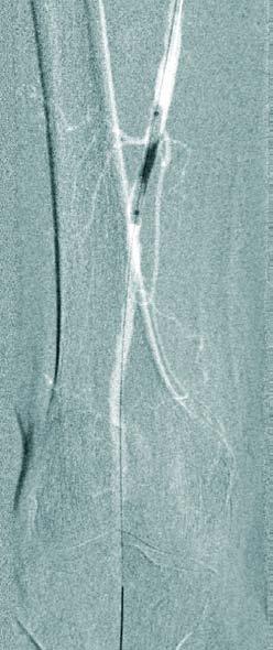 Ballonaufdehnung einer hochgradigen Einengung der Oberschenkelarterie (Arteria femoralis superficialis).