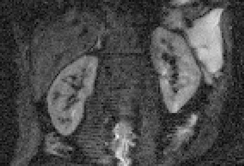 2 Grundlagen Abbildung 11: Mit Partial Fourier beschleunigte diffusionsgewichtete (b=700s/mm 2 ) Aufnahmen der Niere. Im linken Bild sind beide Nieren zu sehen.