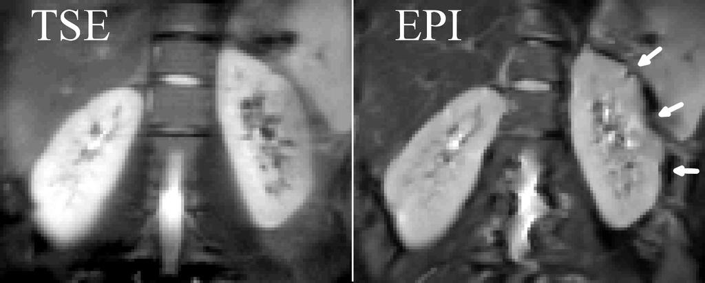 5 Ergebnisse Abbildung 26: T 2 -gewichtetes TSE und EPI Bild (b = 0s/mm 2 ). Das EPI Bild zeigt starke Verzerrungen (Pfeile), die auf dem TSE Bild nicht zu sehen sind.