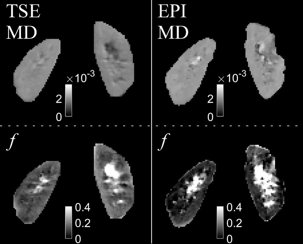 5 Ergebnisse Abbildung 27: IVIM Parameterkarten aufgenommen mit TSE (links) und EPI (rechts), gleicher Bildausschnitt wie in Abb. 26. Oben: Mittlere Diffusivität MD [mm 2 /s]. Unten: Flussanteil f.