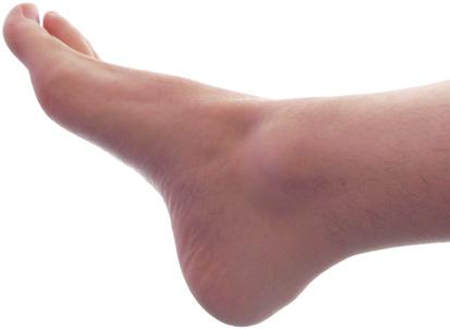 Welchen Belastungen darf der Fuß nach der Operation ausgesetzt werden? Wie kann optimal eine Druckentlastung erreicht werden? u.ä.