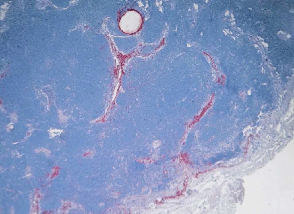Endometrioseläsionen und -Zellen in SLN medulla trabeculae subcapsular sinus superficial cortex capsulae 33% Endometrioseläsionen 73% ER/PR pos.