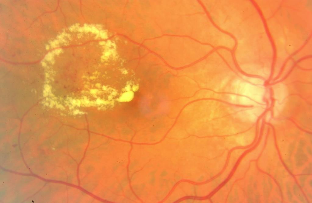 Einteilung der diabetischen Retinopathie Nichtproliferative diab.. Rp.