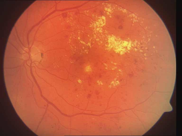 Papillenproliferation Periphere Proliferation Präretinale retinale
