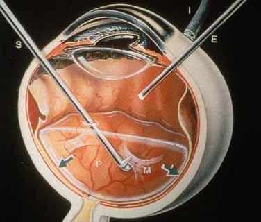 Die Netzhaut - Glaskörper - Chirurgie = Pars plana Vitrektomie wird bei massiver