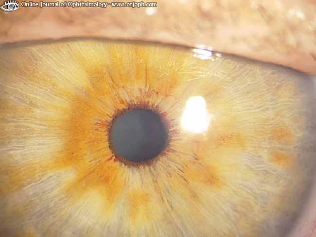 Sekundär-Glaukom Durch Sauerstoffmangel bedingt