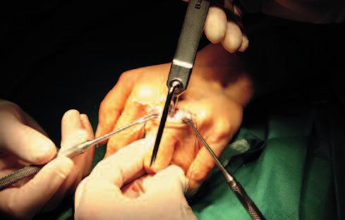 Elogenics Fingerprothese 11 Durch leichte Hammerschläge wird der Lamellenschneider in die Basis der Grundphalanx eingeschlagen.