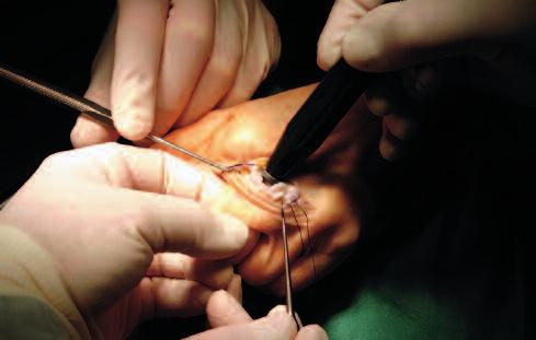 Elogenics Fingerprothese 13 Zu beachten Mit Hilfe des gebogenen Flachmeissels wird, entsprechend der Nase am Implantat, Knochen am Os metarcapale entfernt, sodass die Prothesenschulter der