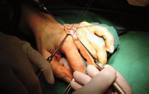 14 Elogenics Fingerprothese Behandlung der Weichteile Die Seitenbänder werden reinseriert bzw. rekonstruiert.