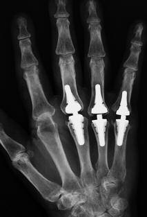 16 Elogenics Fingerprothese Fallbeispiele
