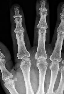 Röntgenaufnahmen der rechten Hand in zwei Ebenen 12