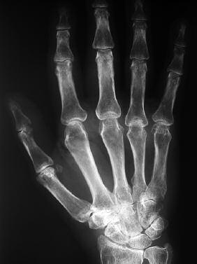 8 Elogenics Fingerprothese Präoperative Planung Für die Operationsplanung sind 3 Röntgenbilder erforderlich: 1. Röntgenaufnahme in A/P 2.
